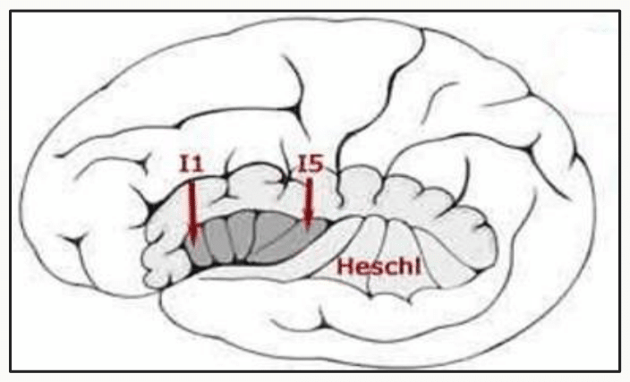Aire de Heschl située sur la face supérieure du gyrus temporal supérieur