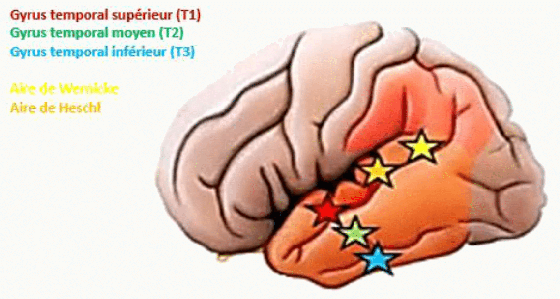 Aires du langage sur les gyrus temporaux et aire auditive de Heschl