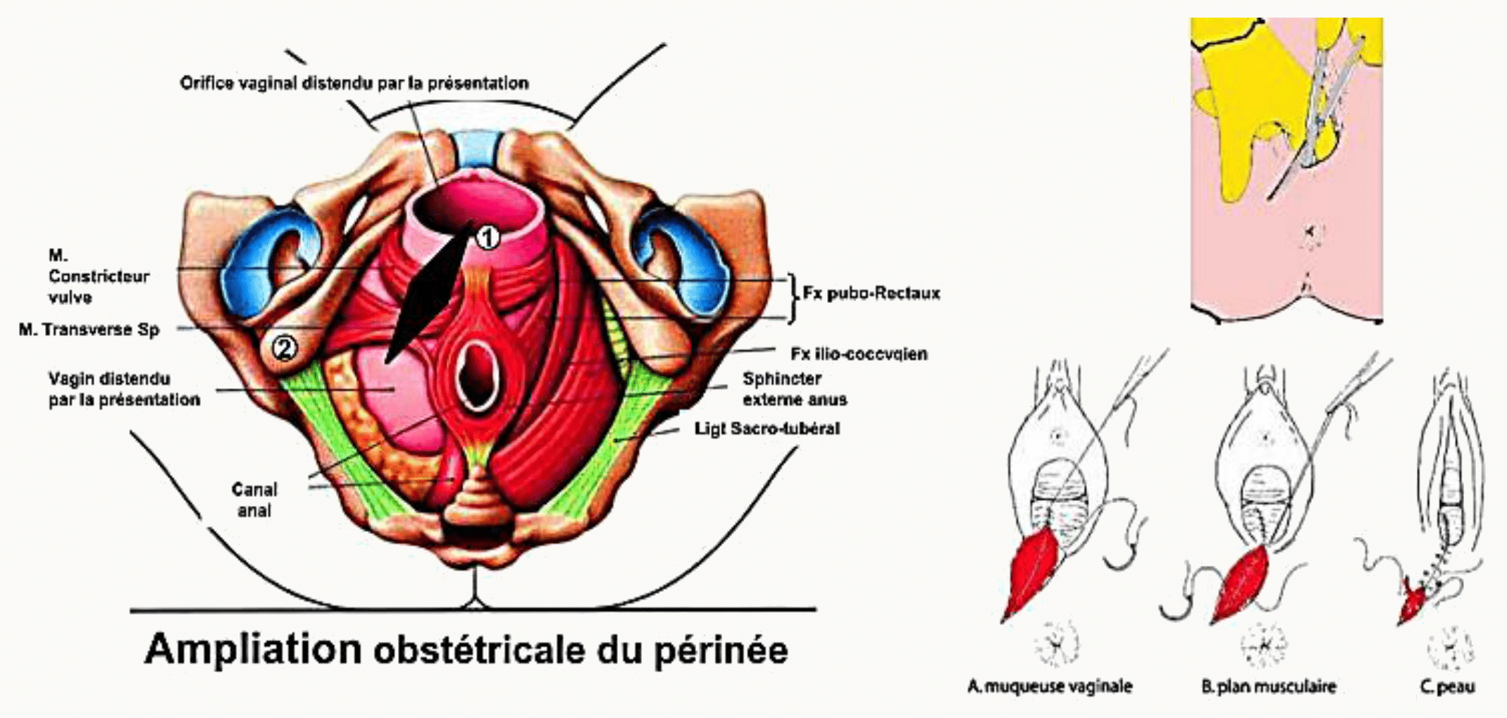 Ampliation obstétricale du périnée lors de l'accouchement et tracés d'épisiotomie