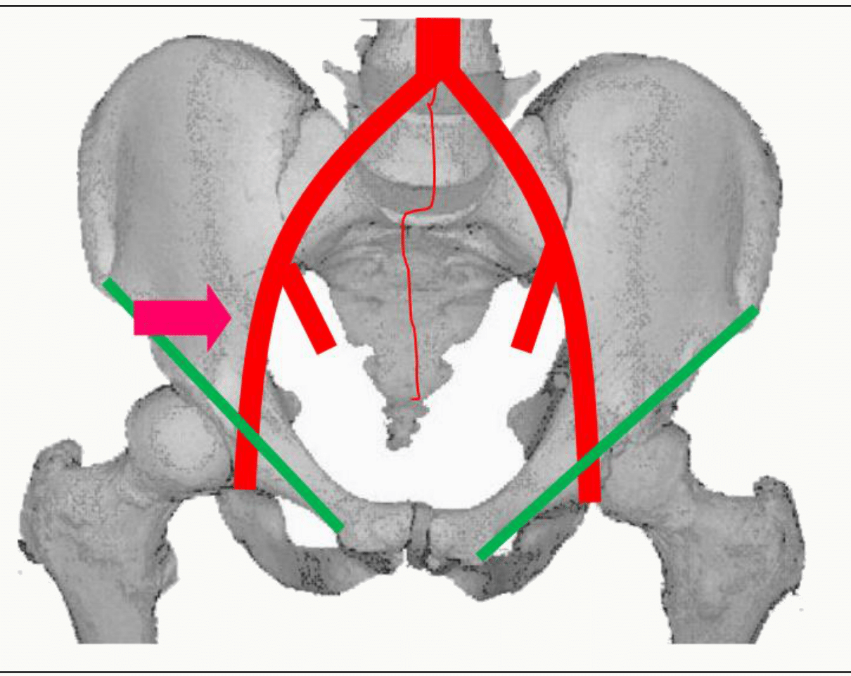 Artère iliaque externe et son trajet vers le membre inférieur