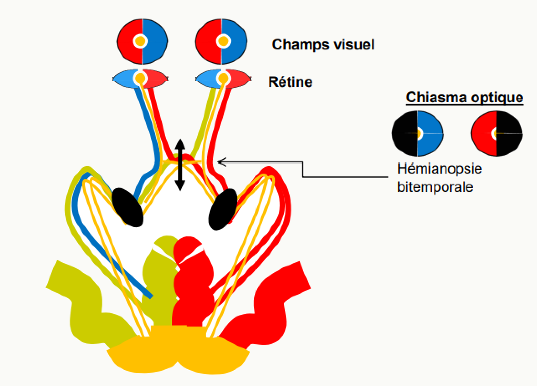 Chiasma optique au-dessus de la selle turcique et hémianopsie bitemporale par compression