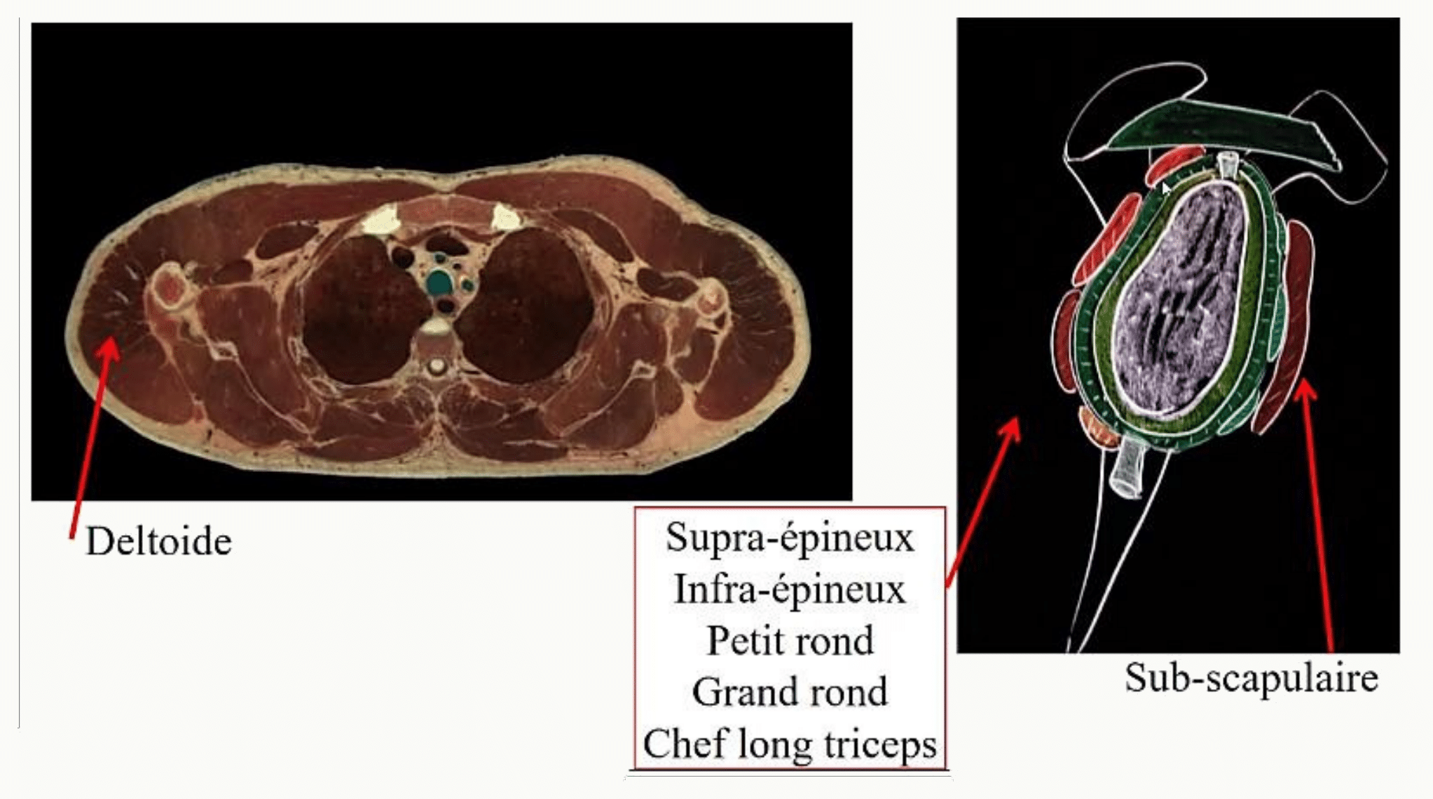 Coupe axiale de l'épaule montrant le deltoïde, les muscles de la coiffe et le long chef du triceps