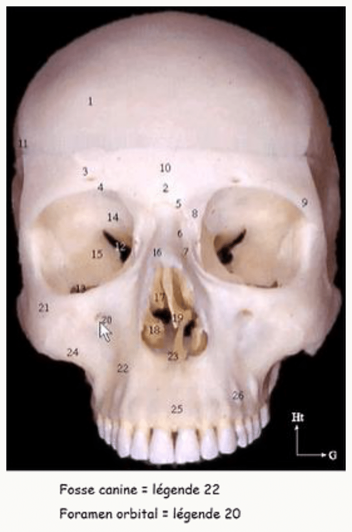 Crâne en vue antérieure avec la fosse canine et le foramen infra-orbitaire