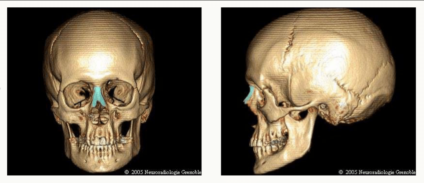Crâne en vues antérieure et inférieure du massif facial