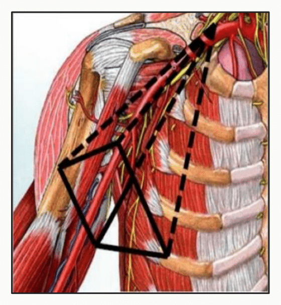Creux axillaire en dissection montrant son contenu vasculo-nerveux
