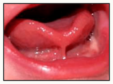 Face inférieure de la langue et frein lingual, en photographie