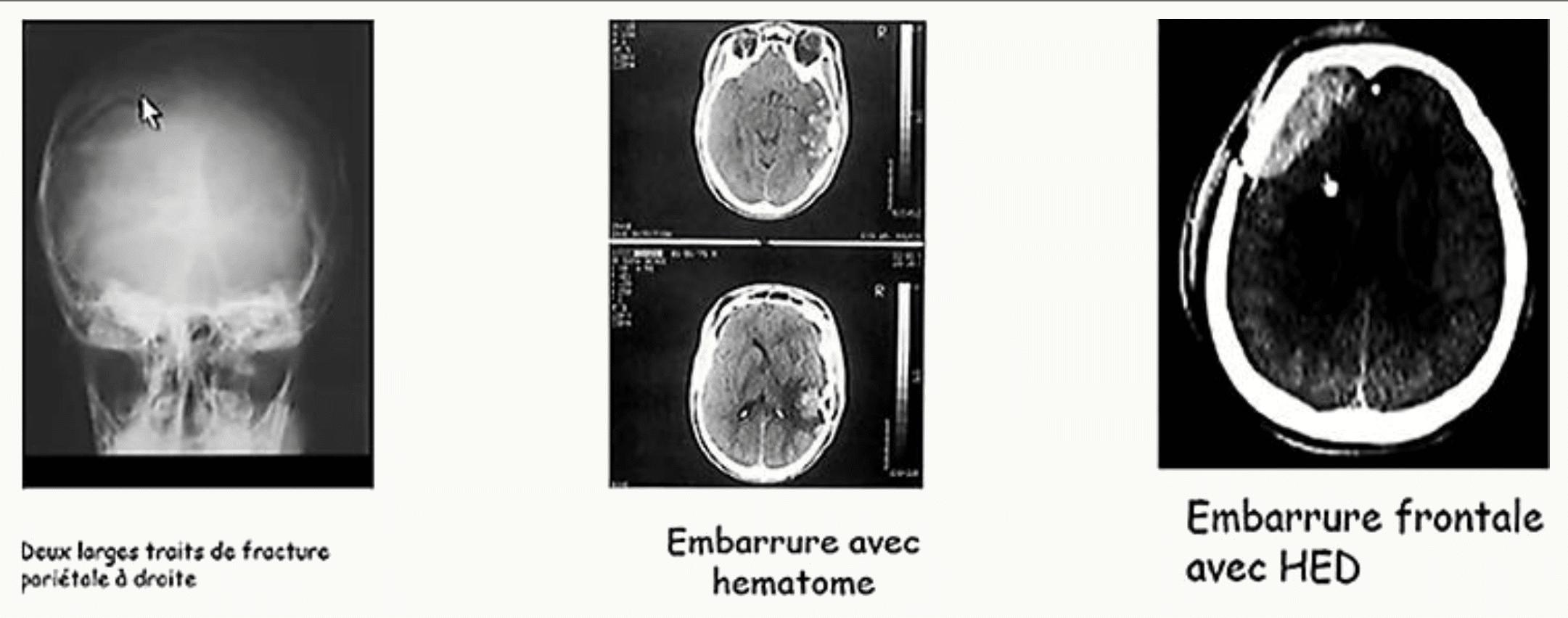 Radiographies et scanners montrant une embarrure et un hématome extra-dural frontal