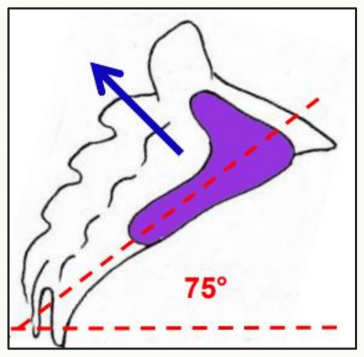 Inclinaison de la surface auriculaire du sacrum, formant un angle de 75 degrés