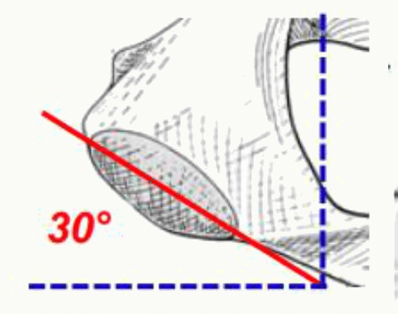 Inclinaison du détroit supérieur formant un angle de 30 degrés avec l'horizontale