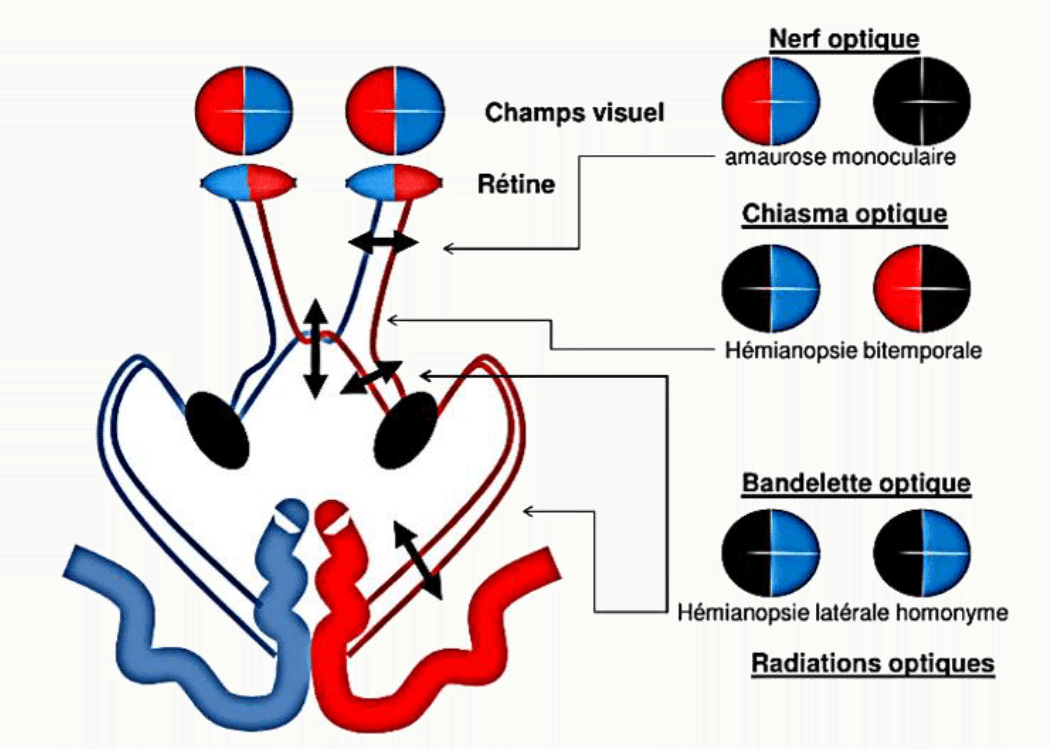 Lésions des voies optiques et déficits du champ visuel correspondants : amaurose, hémianopsies