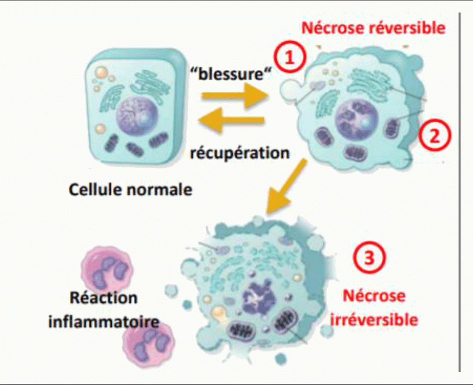 Nécrose réversible et irréversible, avec libération du contenu cellulaire et réaction inflammatoire