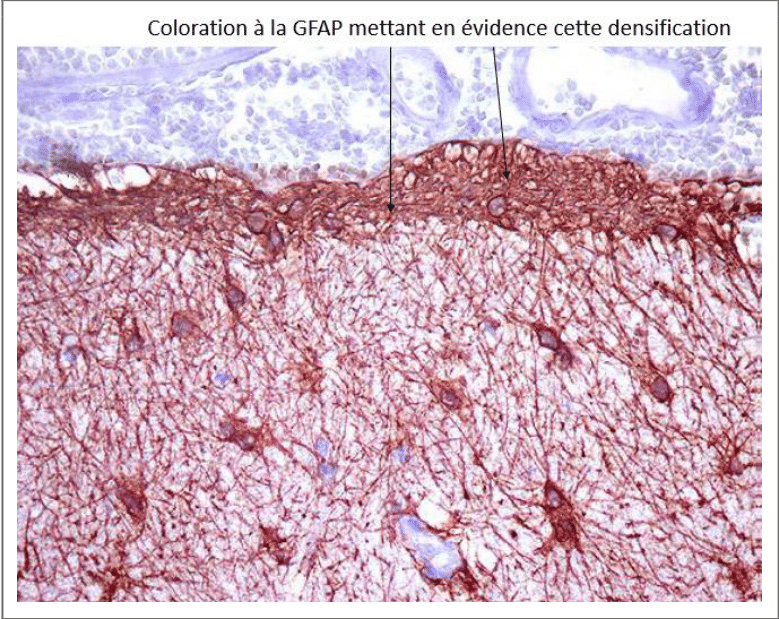 Densification du réseau astrocytaire mise en évidence par la GFAP