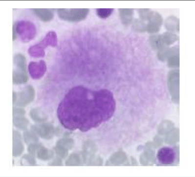 Gros plan d'un leucocyte et de plaquettes sur un frottis sanguin
