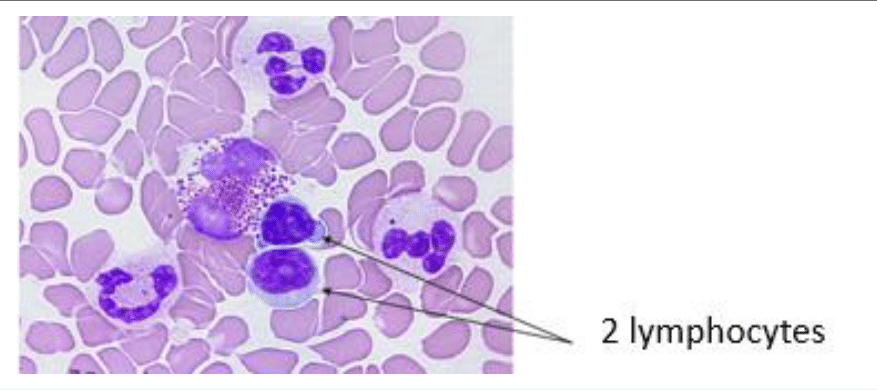 Lymphocytes au noyau arrondi et dense sur un frottis sanguin
