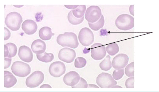 Plaquettes sanguines entre les hématies d'un frottis