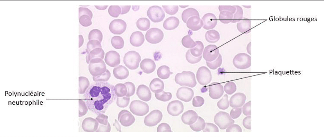 Frottis sanguin montrant globules rouges, plaquettes et un polynucléaire neutrophile