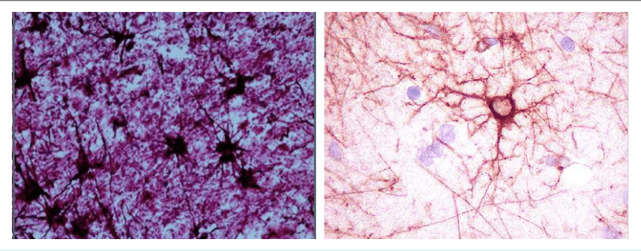 Astrocytes étoilés révélés par immunomarquage de la GFAP