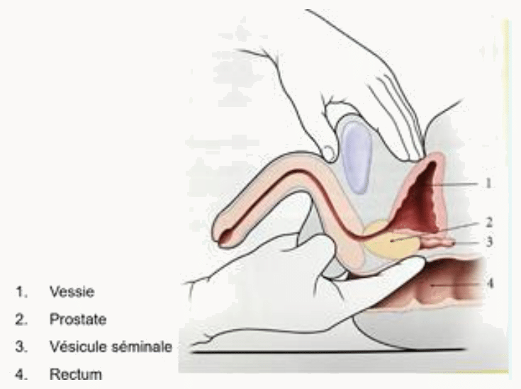 Prostate et vésicules séminales et leurs rapports avec la vessie en haut et le rectum en arrière