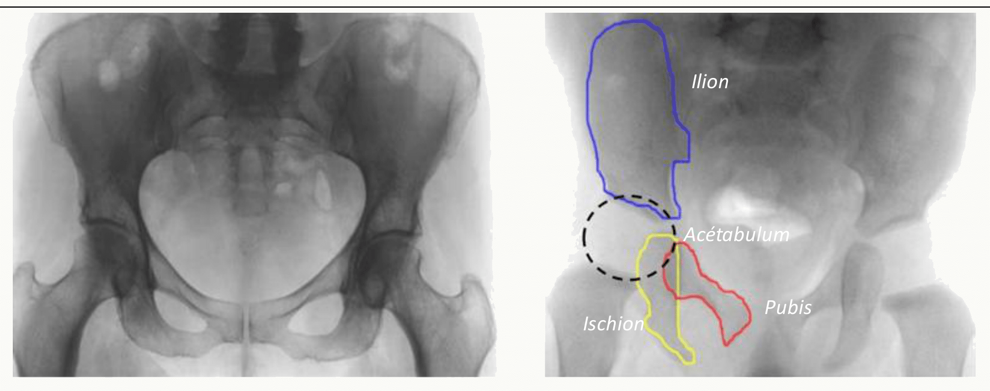Radiographie du bassin accompagnée de son schéma interprétatif