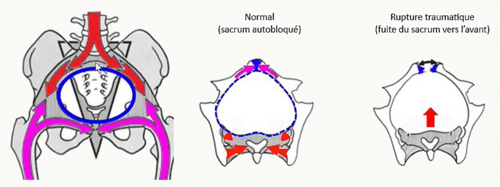 Sacrum stabilisé par ses ligaments et conséquence d'une rupture traumatique
