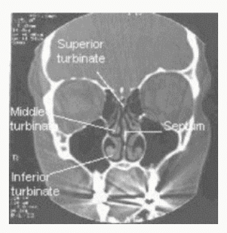 Scanner coronal montrant les cornets supérieur, moyen et inférieur et le septum