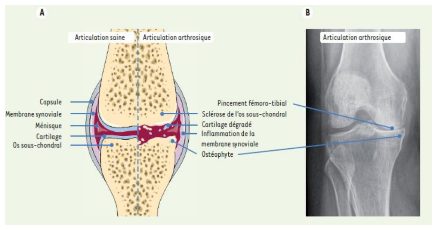 Cellules souches et arthrose