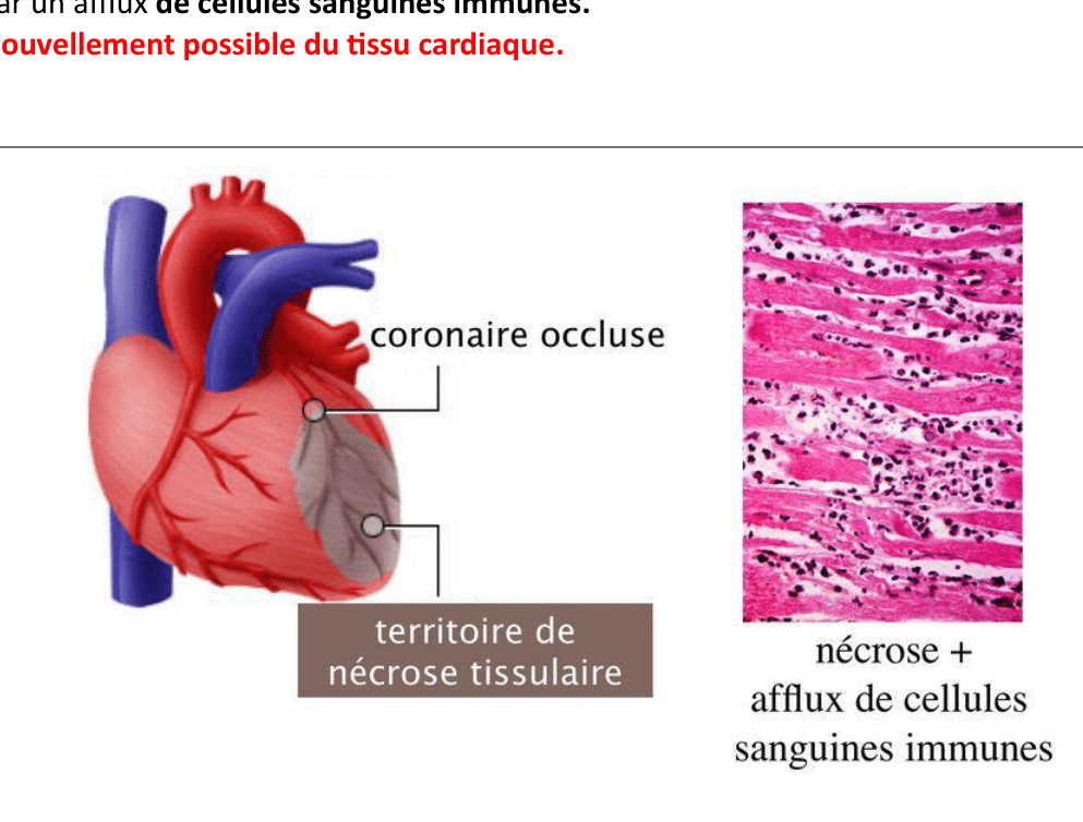 Infarctus du myocarde : occlusion coronaire et territoire de nécrose du muscle cardiaque
