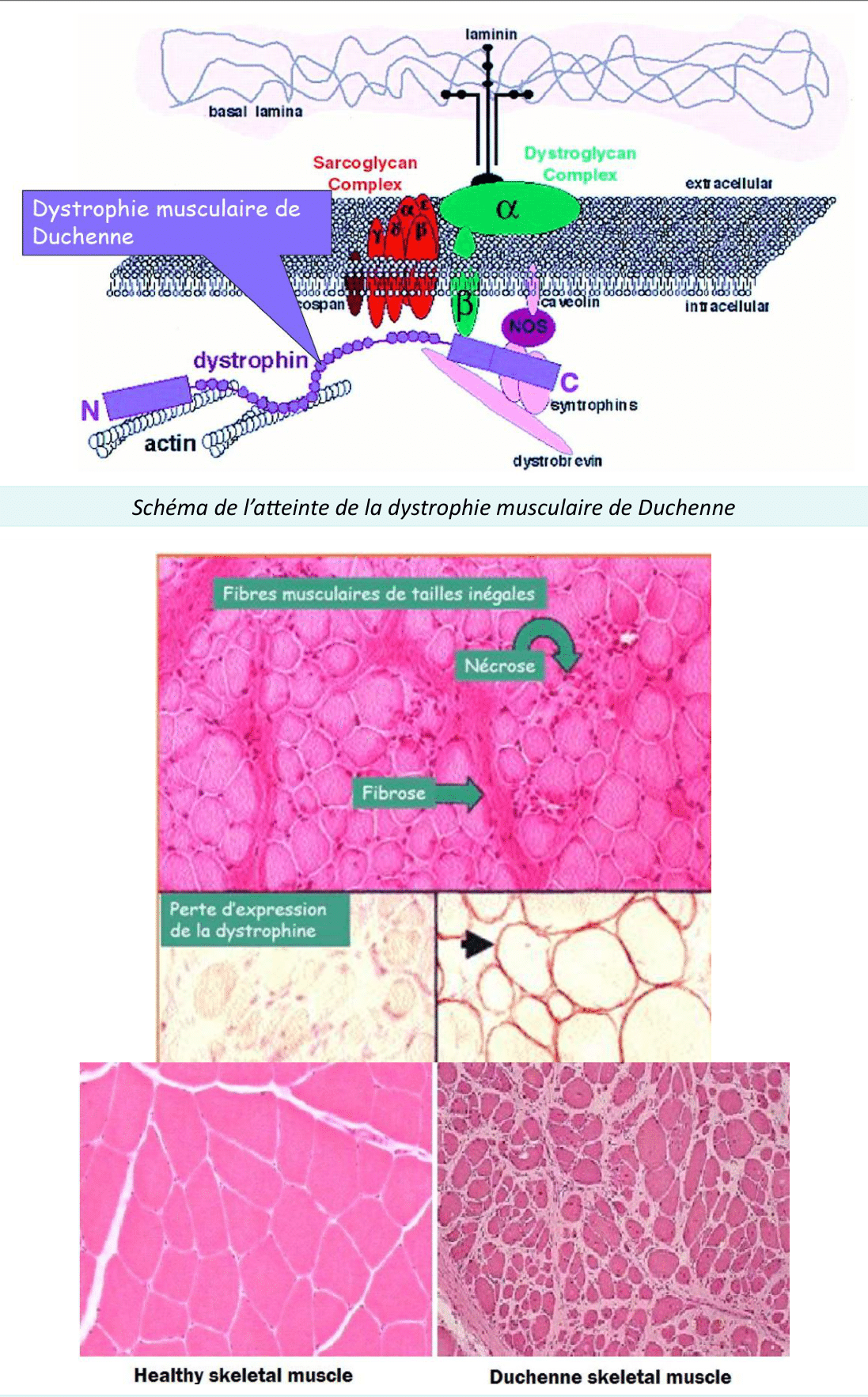 Dystrophie musculaire de Duchenne comparée à un muscle sain, en schéma et histologie