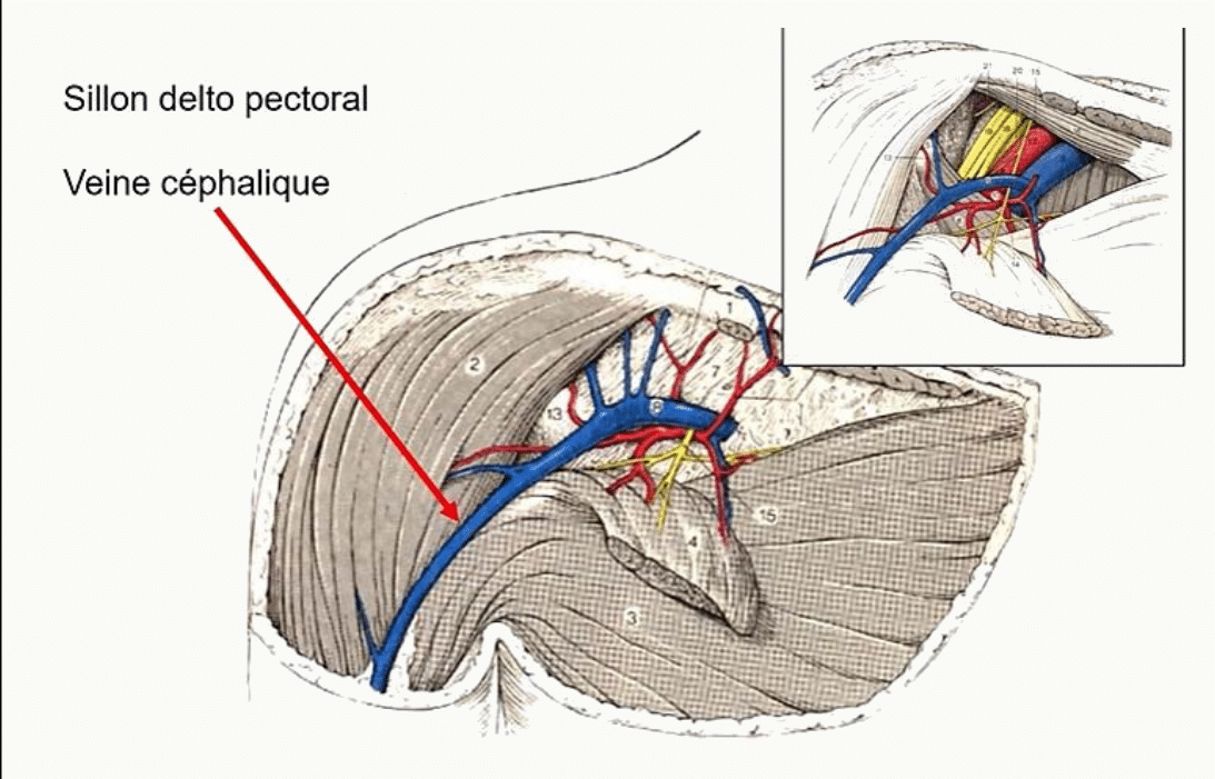 Sillon delto-pectoral et veine céphalique qui s'y engage