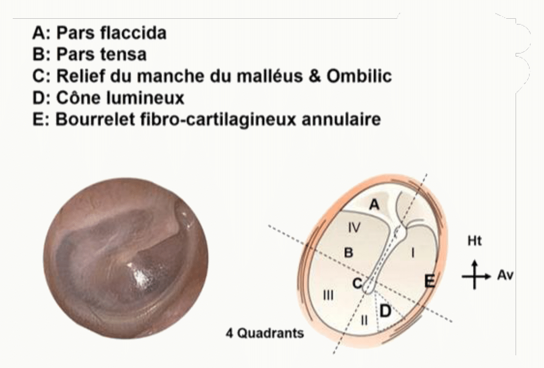 Tympan avec la pars flaccida, la pars tensa, le manche du malléus et ses quatre quadrants