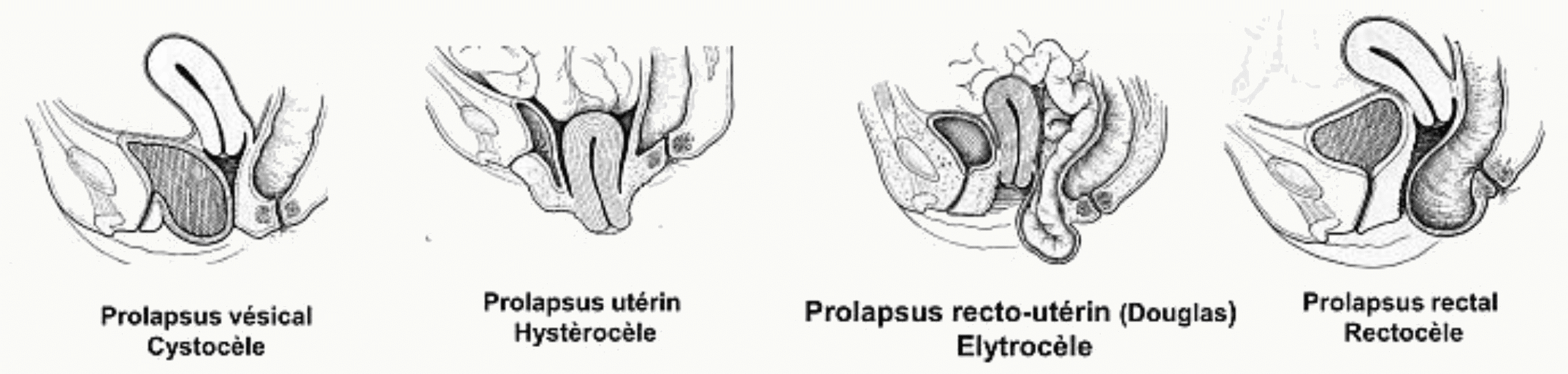 Types de prolapsus : cystocèle, hystérocèle, élytrocèle et rectocèle