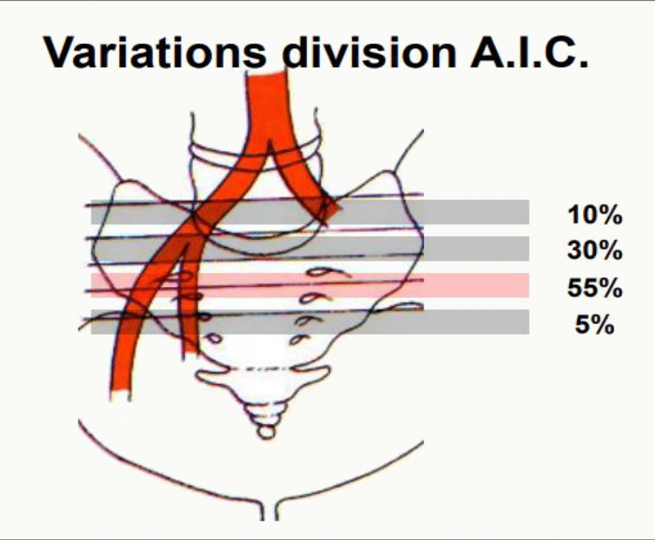 Variations du niveau de division de l'artère iliaque commune et leurs fréquences