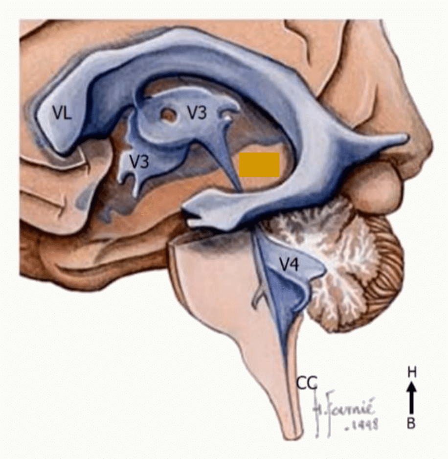 Ventricules latéraux, troisième ventricule et corps calleux en coupe sagittale