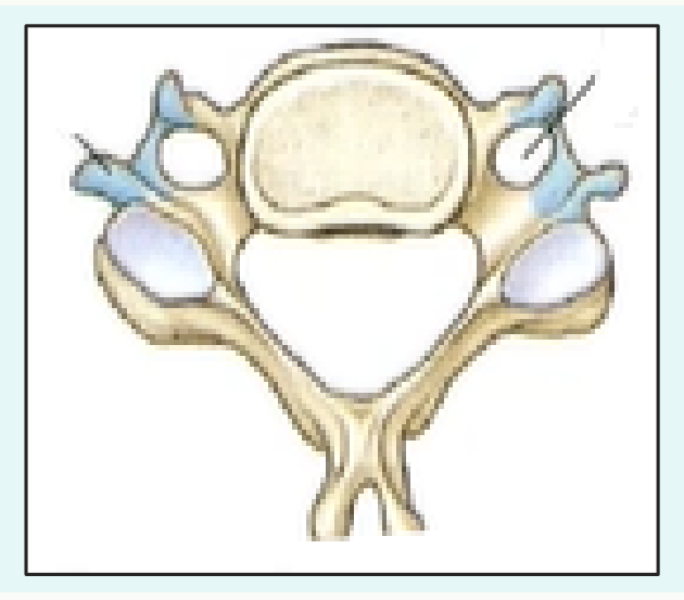 Vertèbre cervicale vue en coupe, avec son foramen vertébral triangulaire