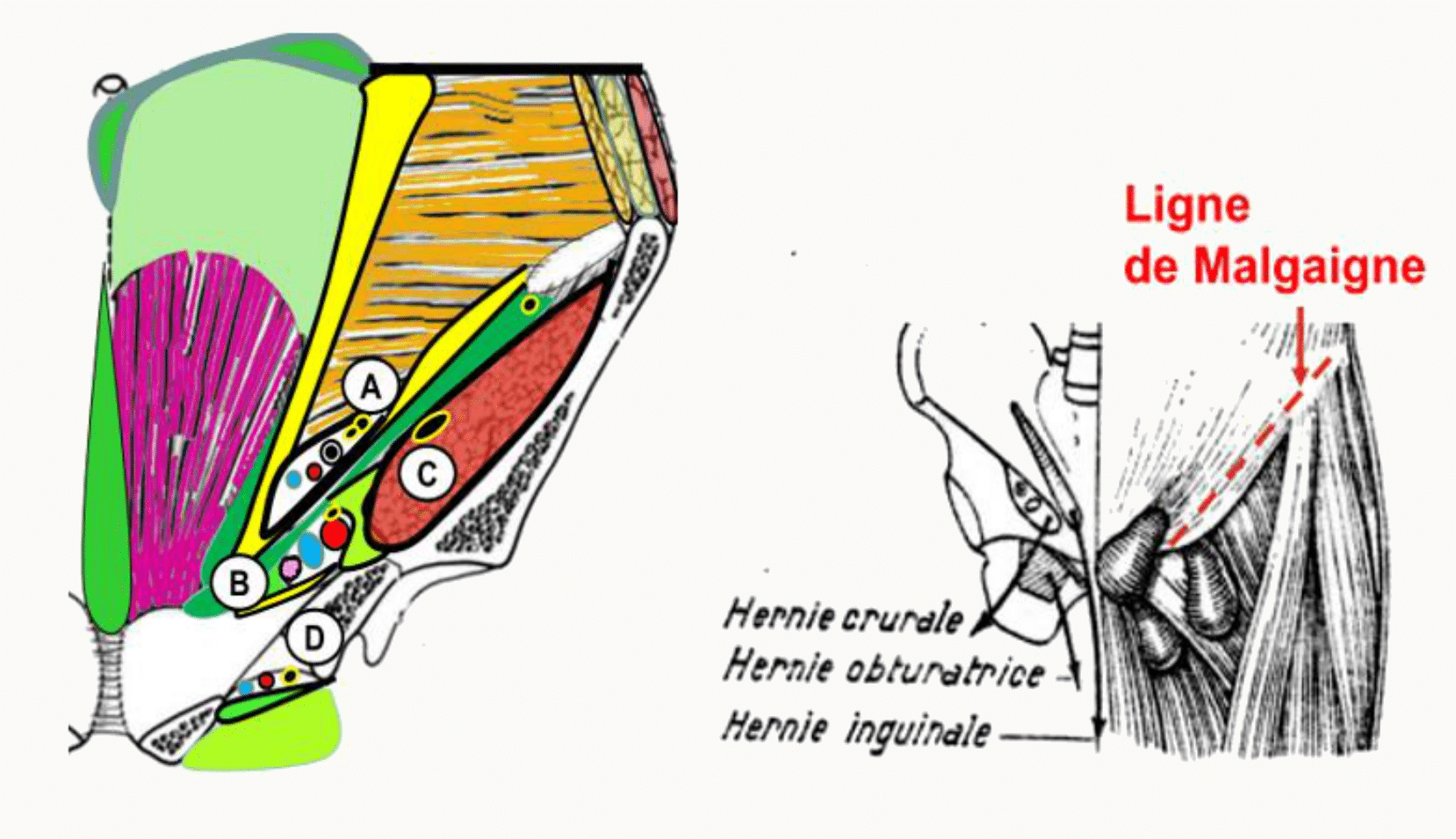 Zones de faiblesse de la paroi et hernies crurale, obturatrice et inguinale, avec la ligne de Malgaigne