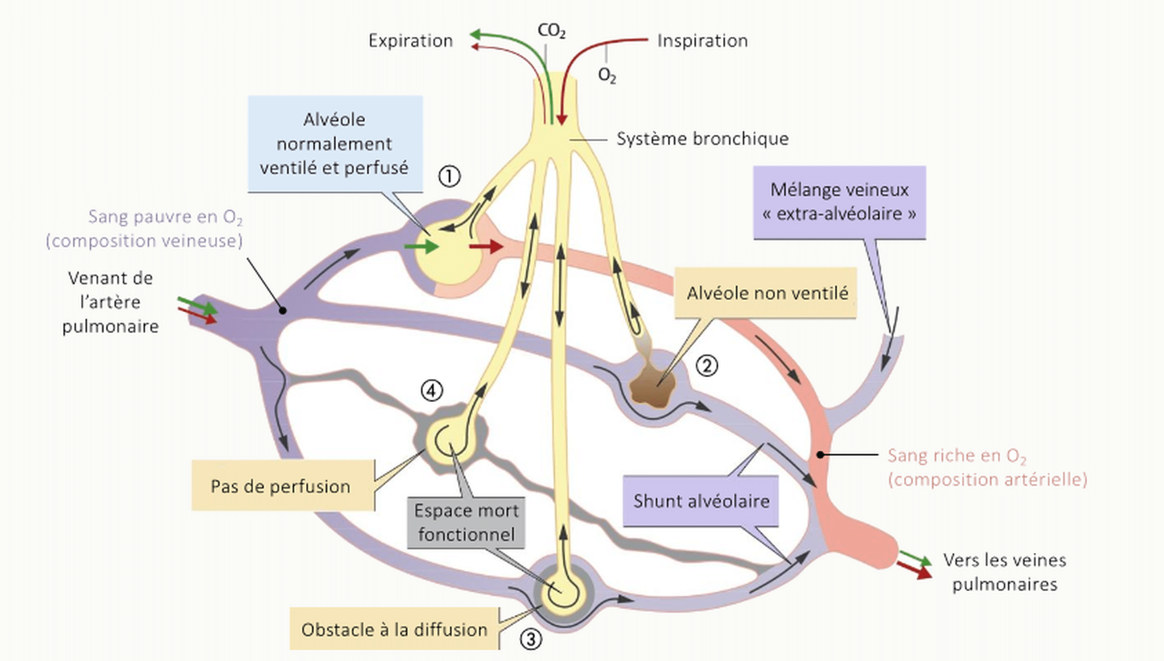 Schéma comparatif des 4 situations alvéolaires : alvéole normale, hypoventilation alvéolaire (shunt), obstacle à la diffusion, espace mort (embolie pulmonaire), avec les rapports V/Q correspondants.