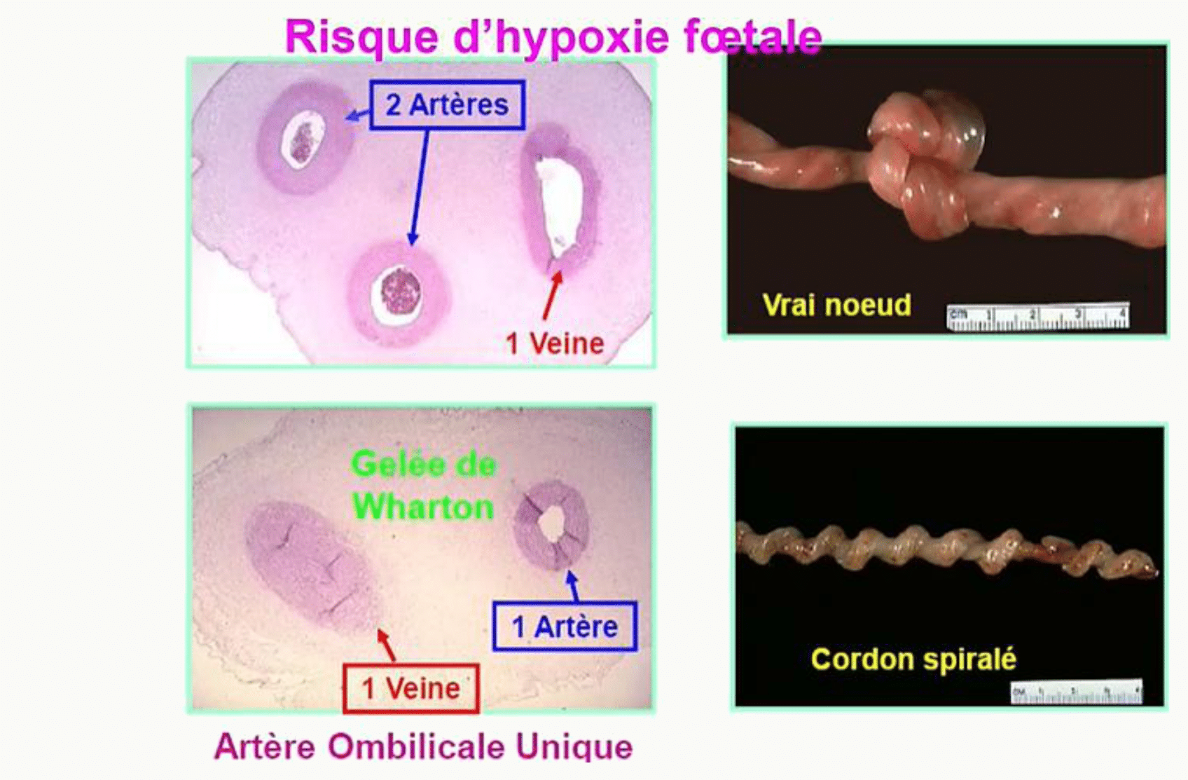 Anomalies du cordon ombilical : artère ombilicale unique et nœud vrai