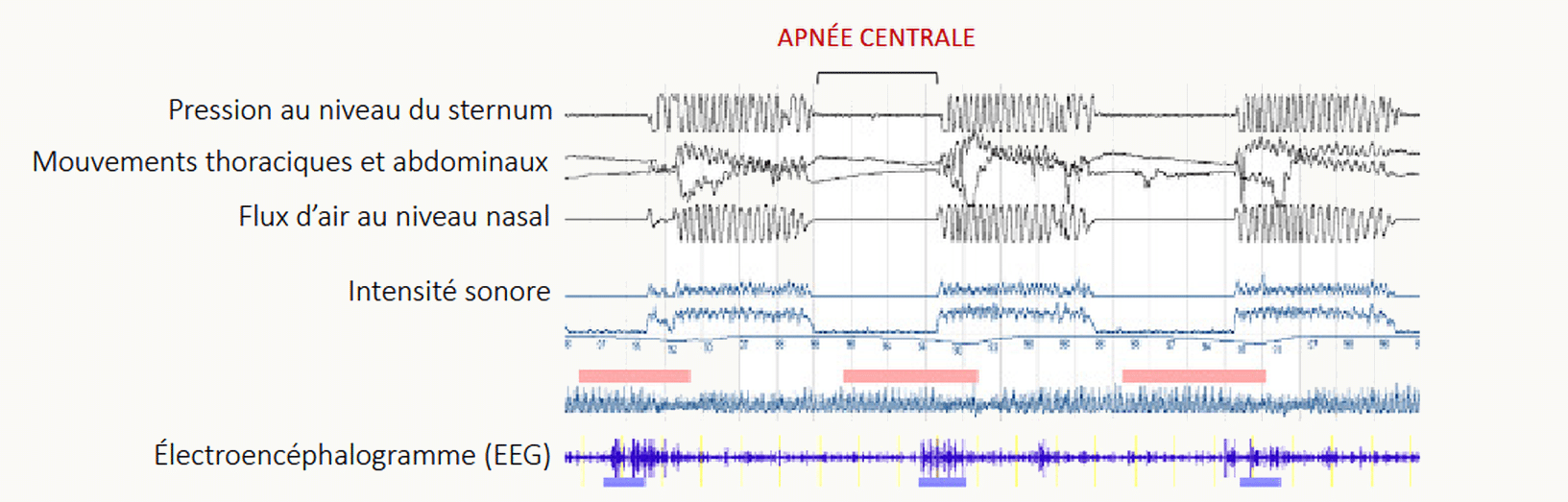 Tracé polysomnographique d'une apnée centrale chez le nouveau-né montrant les signaux de pression au niveau du sternum, mouvements thoraciques et abdominaux, flux d'air au niveau nasal, intensité sonore et électroencéphalogramme (EEG), avec indication de l'apnée centrale.