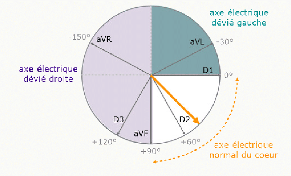 Secteurs de l'axe électrique du cœur sur le cercle de Bailey : normal, dévié gauche, dévié droit.
