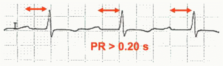 Bloc auriculo-ventriculaire du premier degré : intervalle PR allongé > 0,20 s, chaque P suivie d&rsquo;un QRS. » style= »display:block; width:100%; border-radius:12px; »><figcaption style=