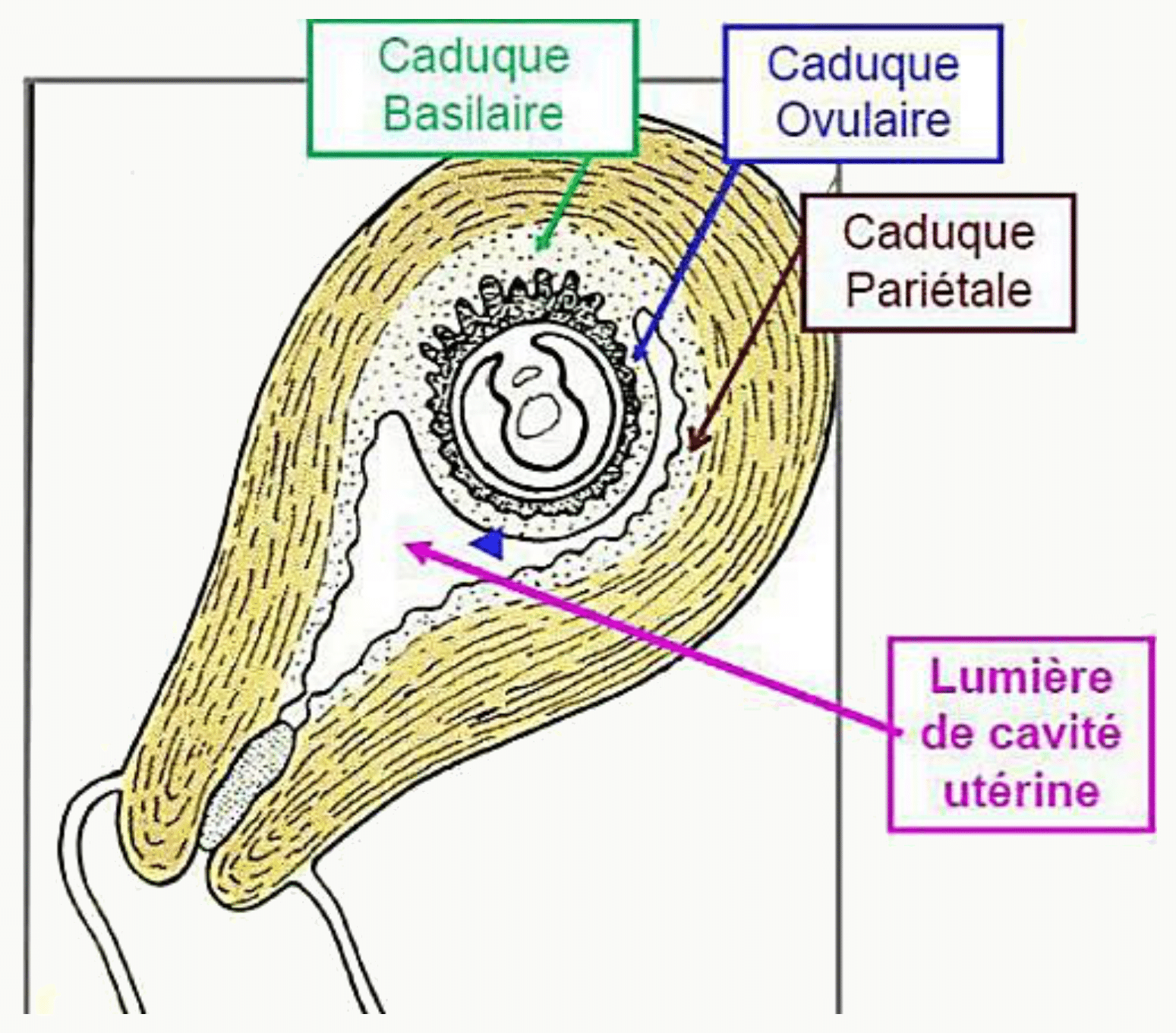 Les trois caduques de l'endomètre : basilaire (sous le placenta), ovulaire (sur le fœtus) et pariétale (reste de la cavité utérine)