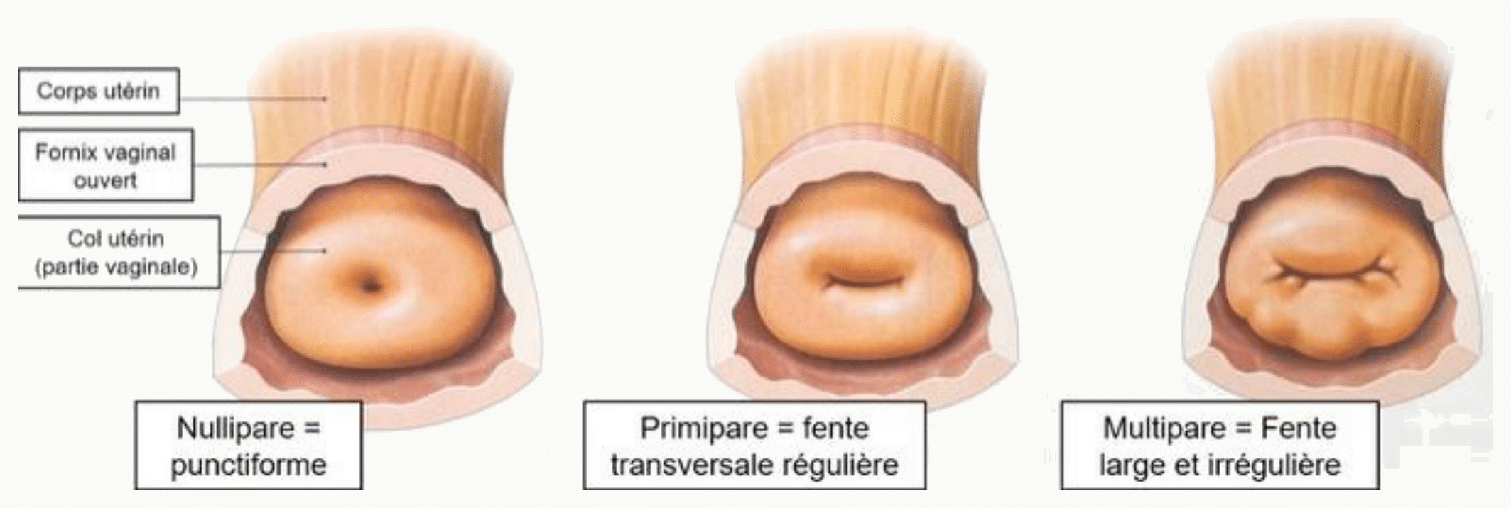 Orifice externe du col utérin chez la nullipare, la primipare et la multipare