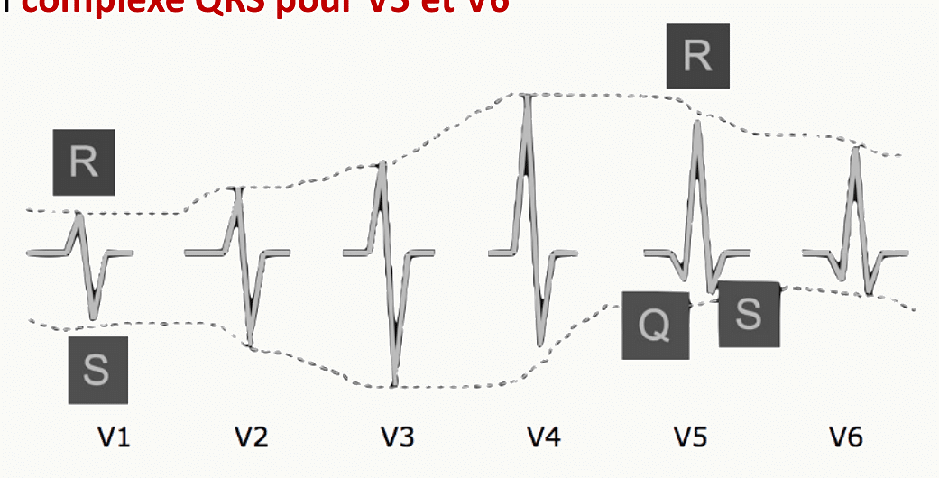 Évolution progressive du complexe QRS de V1 à V6 : rS en V1 devenant qR en V6.