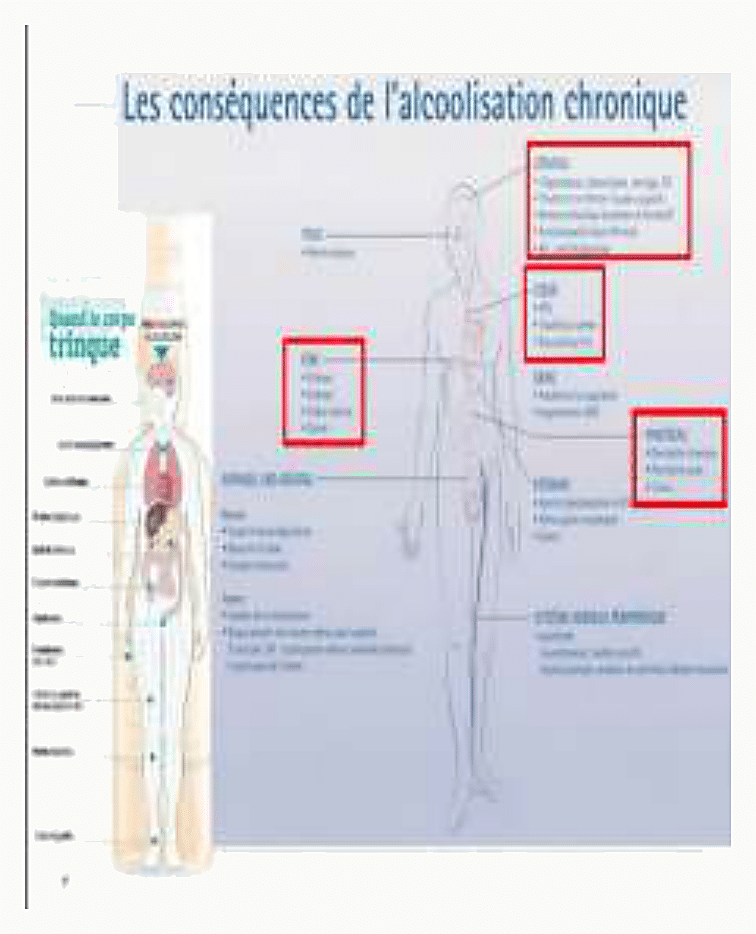 Planche anatomique « Les conséquences de l'alcoolisation chronique » avec zones rouges sur foie (cirrhose, stéatose, cancer), cerveau (dépendance, intoxication, sevrage), cœur (HTA, troubles du rythme, myocardiopathies), pancréas (pancréatite, cancer), estomac et système nerveux périphérique
