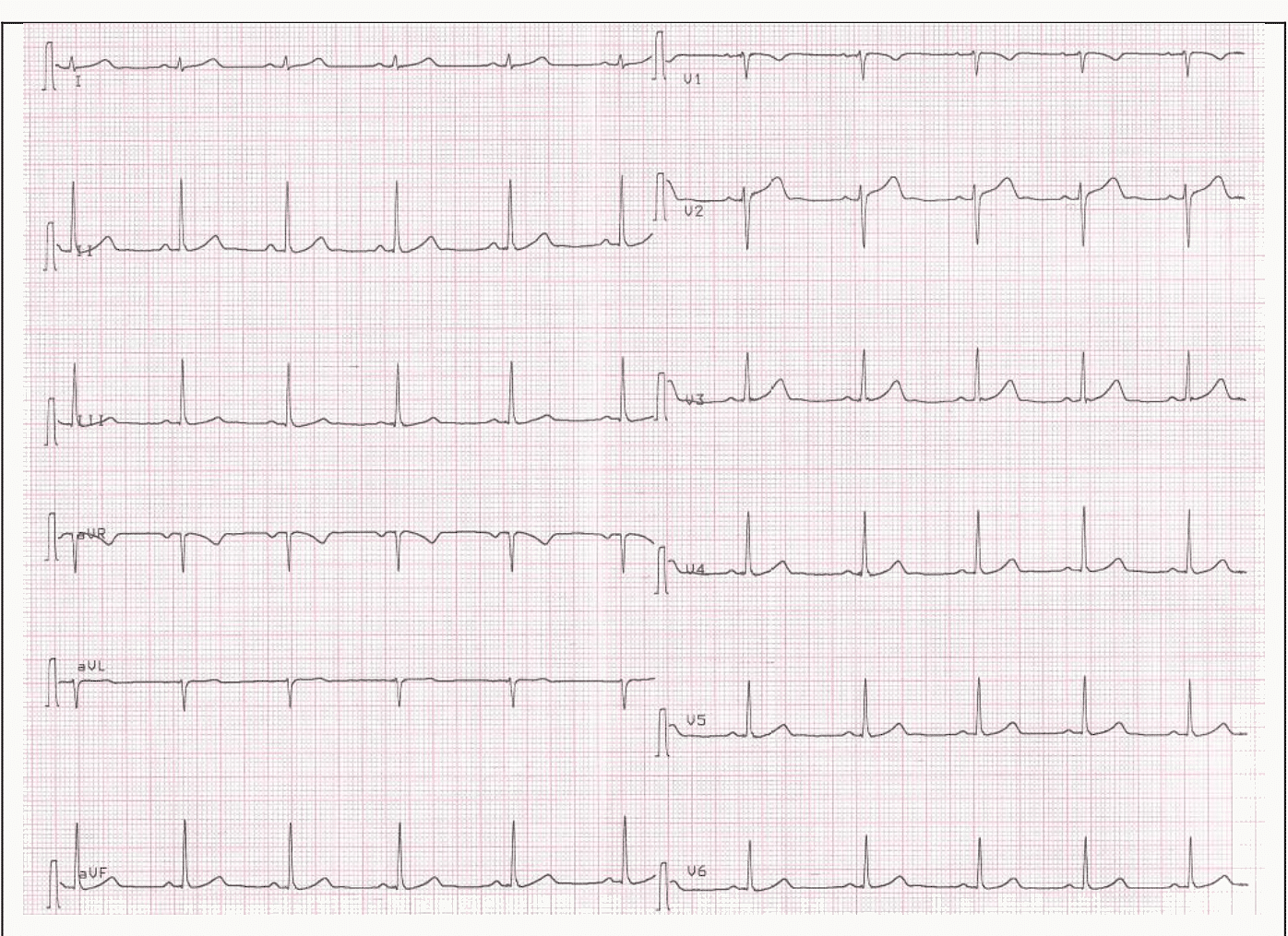 ECG 12 dérivations complet sur papier millimétré.