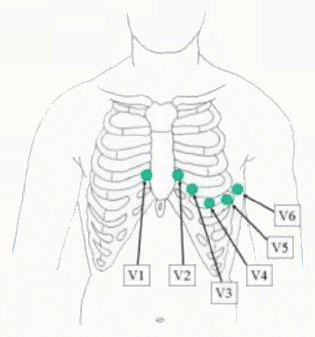 Position des six électrodes précordiales V1 à V6 sur le thorax.