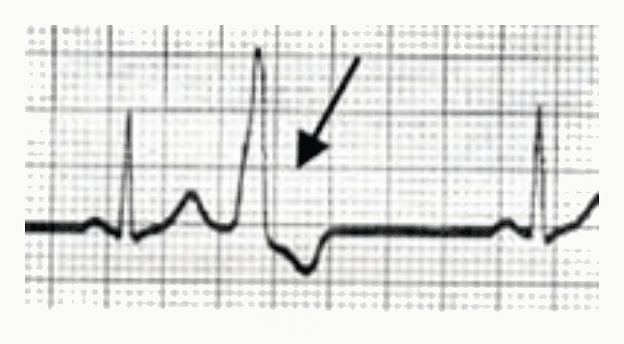 Extrasystole ventriculaire isolée sur un tracé ECG : complexe QRS large et prématuré.