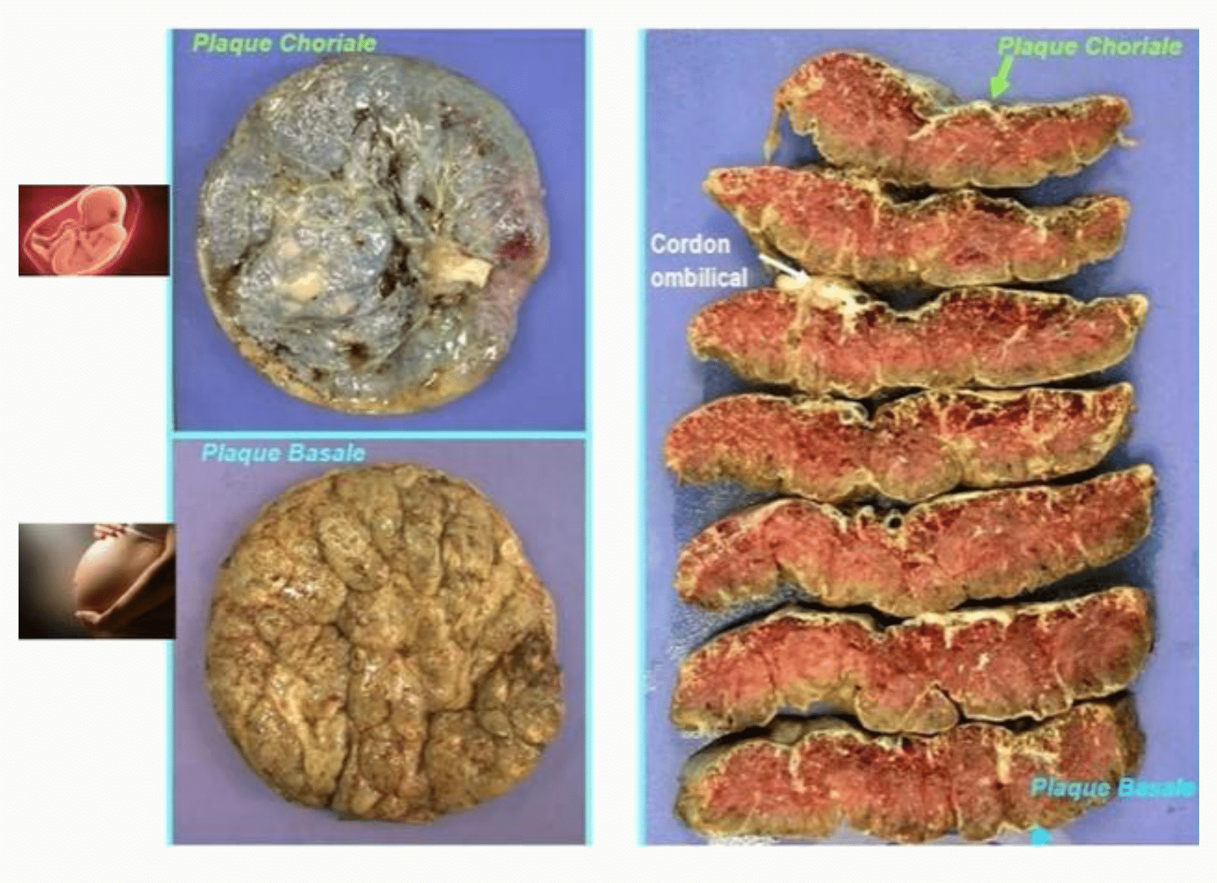 Photographies de la face maternelle du placenta montrant les cotylédons séparés par des sillons