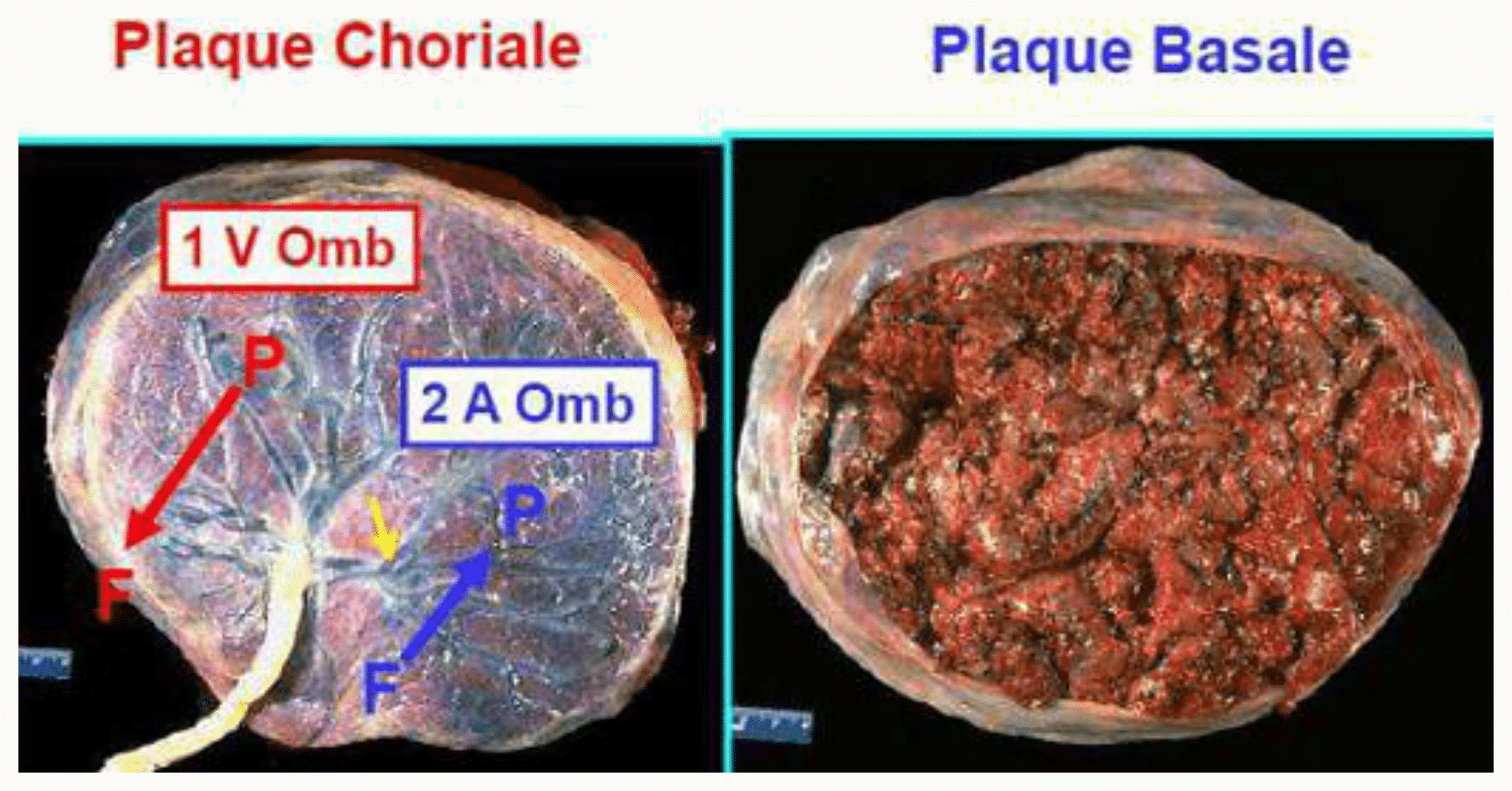 Photographies des faces choriale et basale du placenta