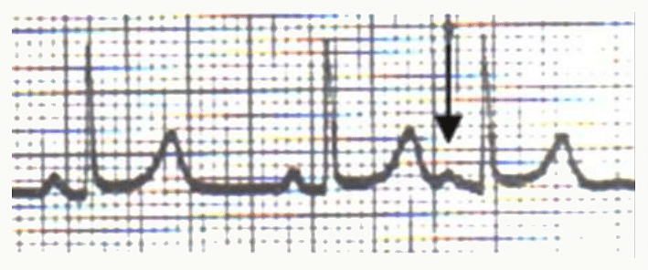 Fibrillation auriculaire : absence d'onde P, ligne isoélectrique irrégulière, QRS irréguliers.